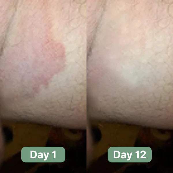 Cirello Antifungal Soap®